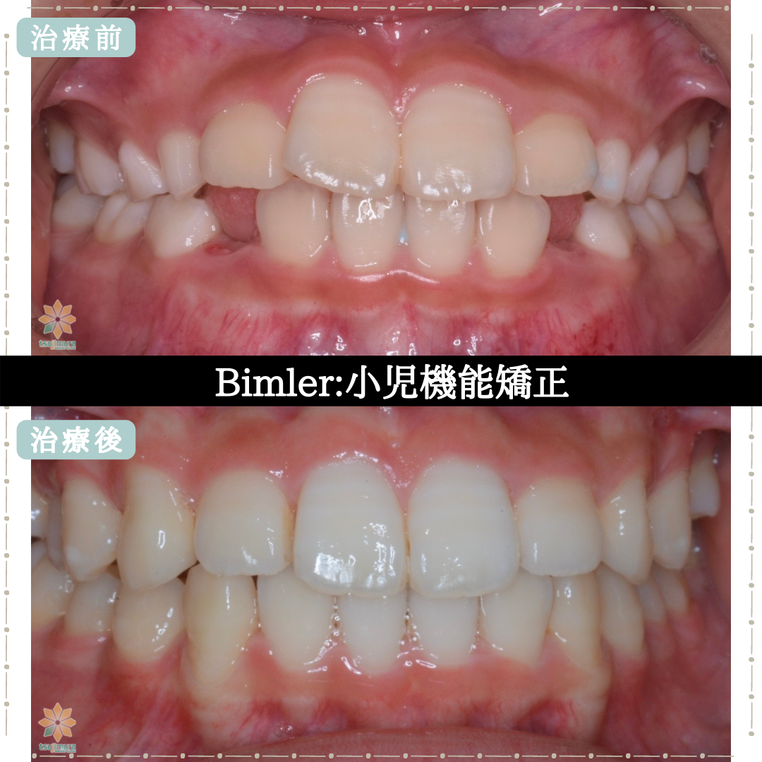 症例6：Bimler:小児機能矯正