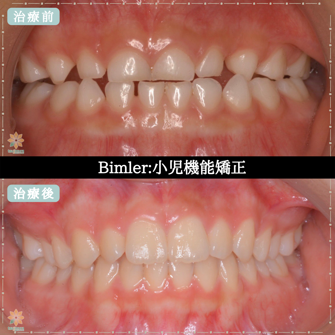 症例４：Bimler:小児機能矯正