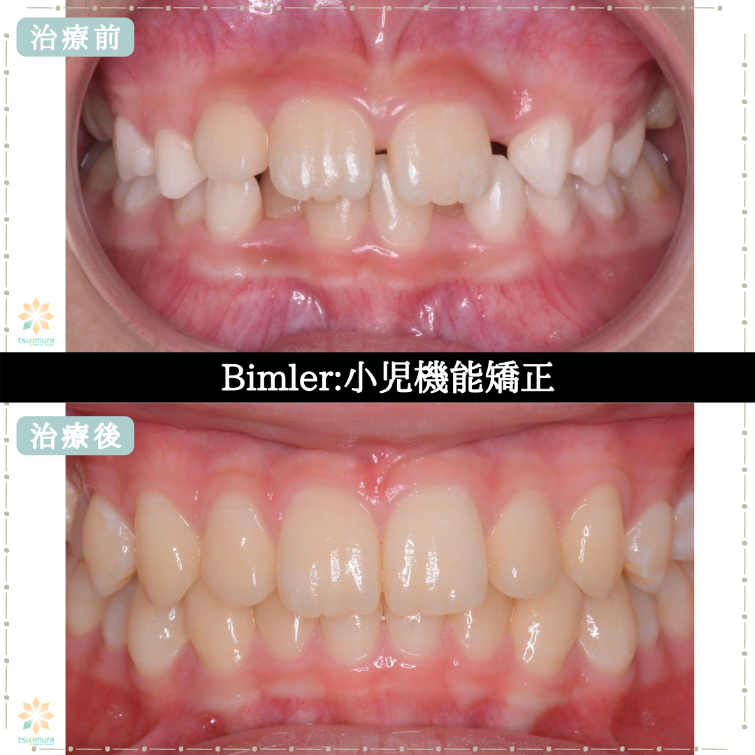 症例５：Bimler:小児機能矯正