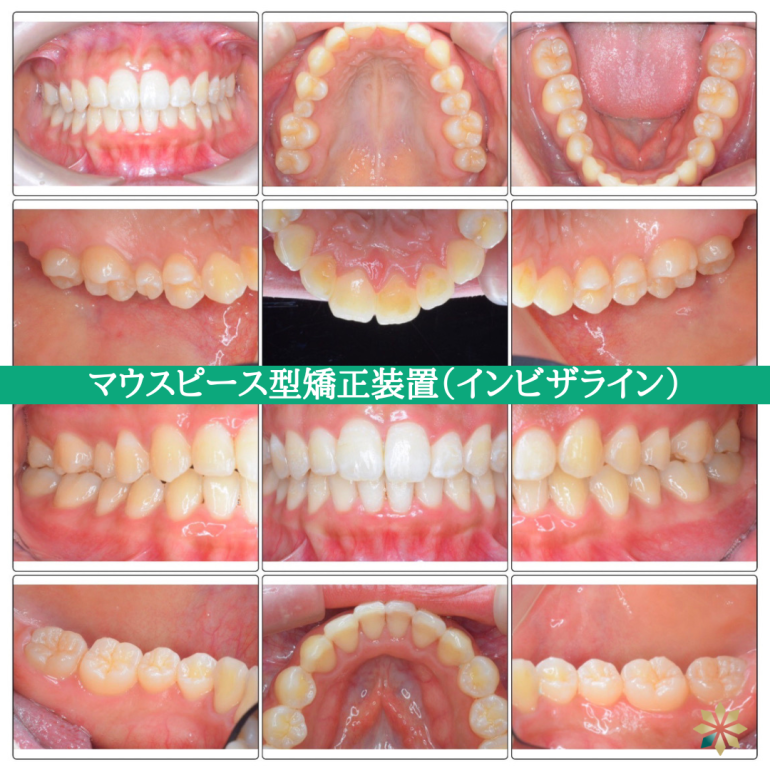 症例11-3_マウスピース型矯正装置