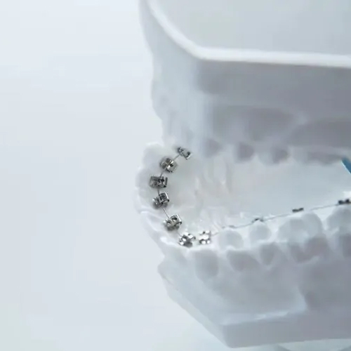 3Dシミュレーションによるクリンチェック