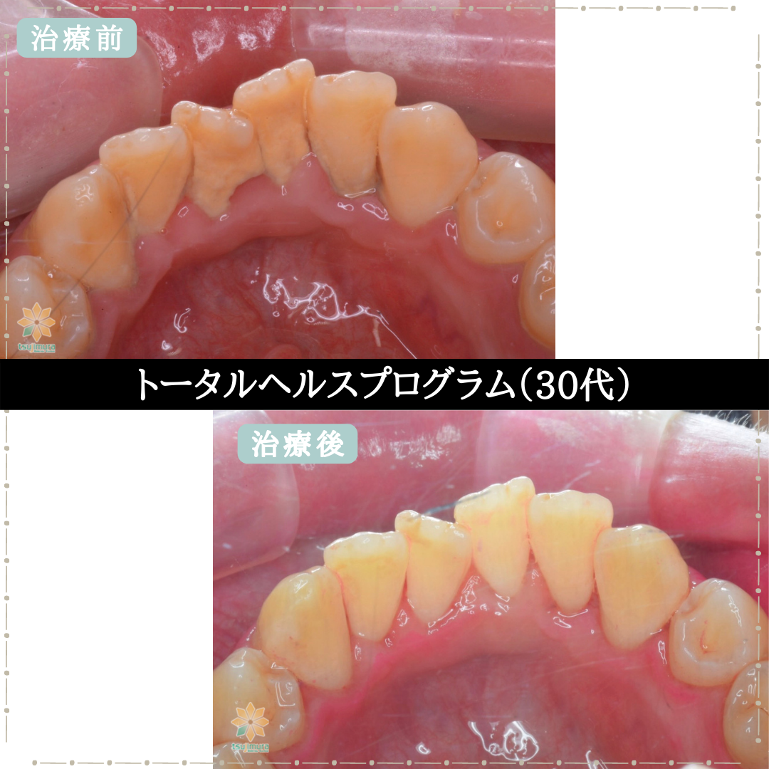 症例５：THP《50代男性》