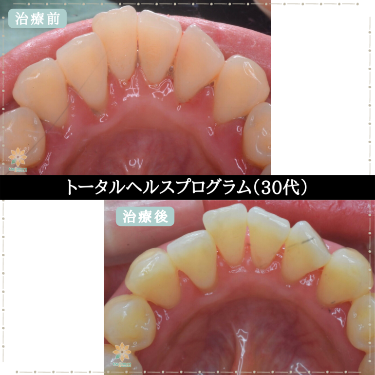 症例６：THP《30代》