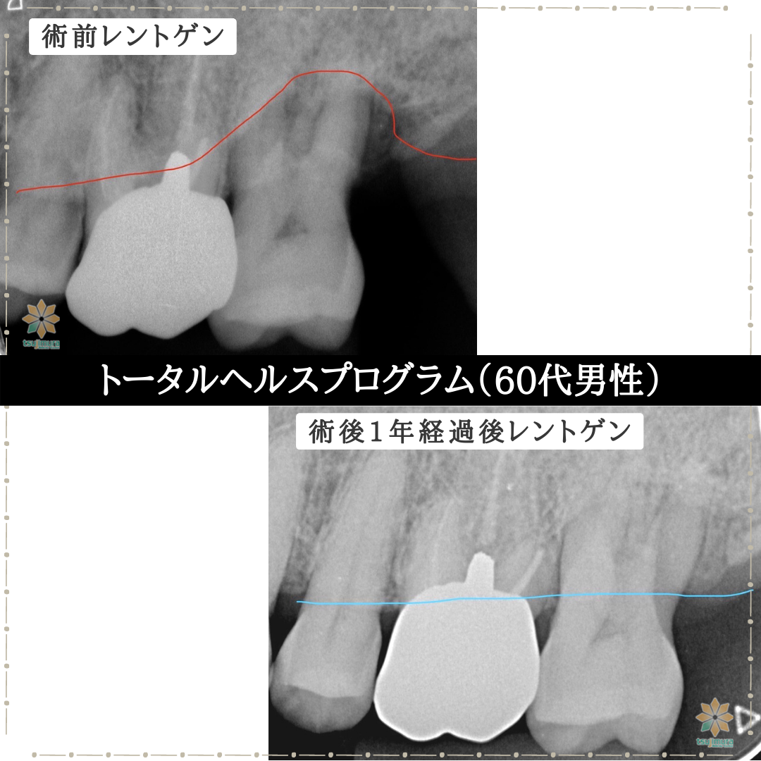 症例８：THP《60代男性》