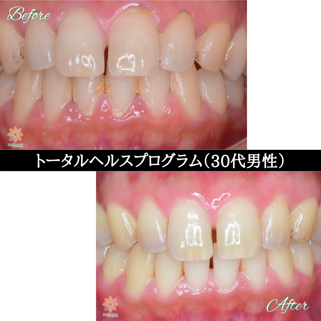 症例７：THP《30代男性》