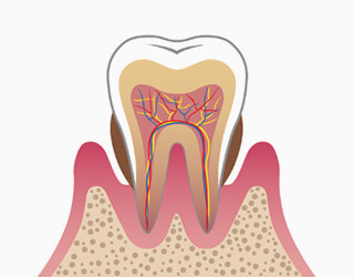 中度の歯周炎