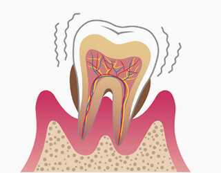 重度の歯周炎