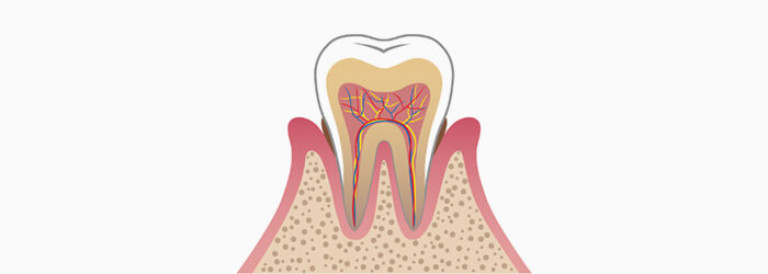 軽度の歯周炎
