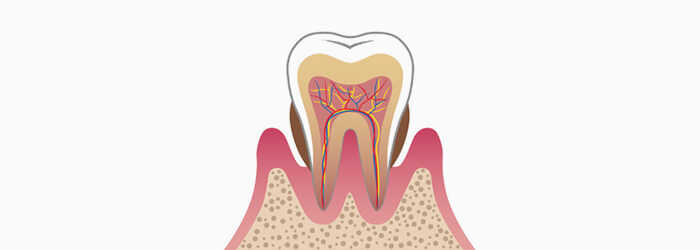 中度の歯周炎