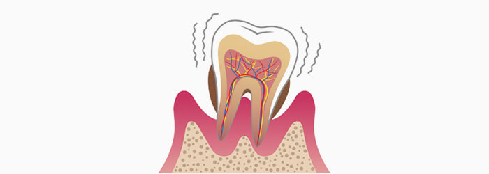 重度の歯周炎