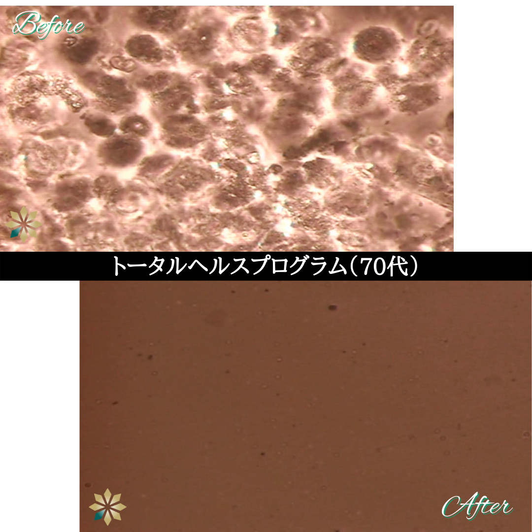 症例９：THP《70代》