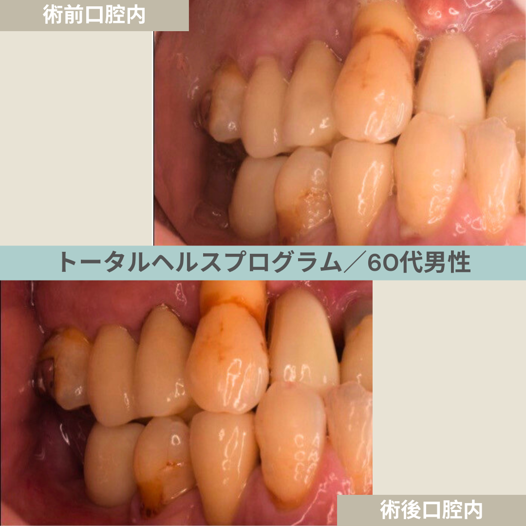 【症例２７】THP_トータルヘルスプログラム｜60代男性