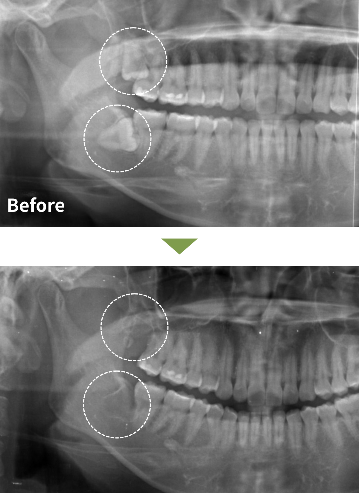 SP_親知らず抜歯症例01｜神奈川県伊勢原市で親知らず抜歯専門外来ならつじむら歯科医院 伊勢原
