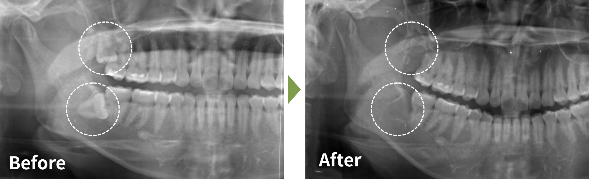 PC_親知らず抜歯症例01｜神奈川県伊勢原市で親知らず抜歯専門外来ならつじむら歯科医院 伊勢原