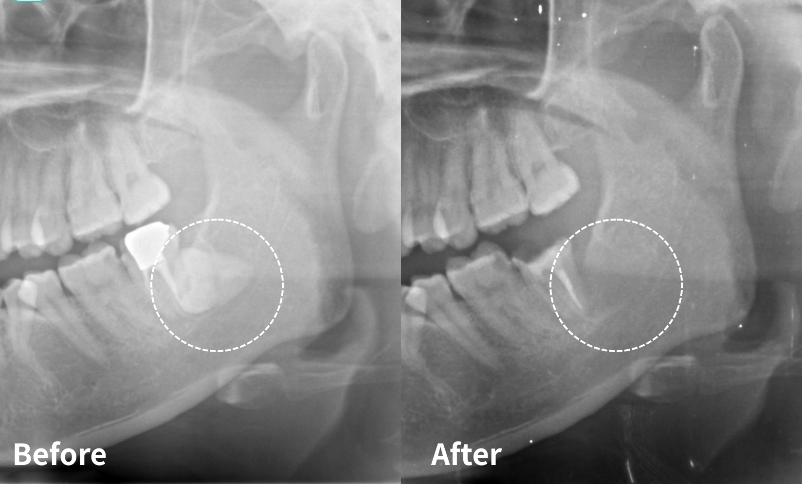 親知らず抜歯症例02｜神奈川県伊勢原市で親知らず抜歯専門外来ならつじむら歯科医院 伊勢原